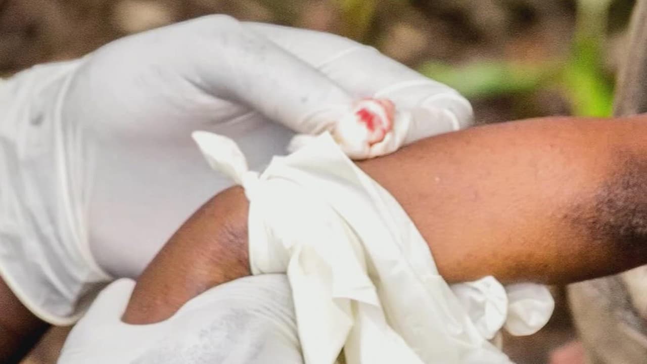 Descubren más casos de viruela del mono en los condados de Orange y Seminole     