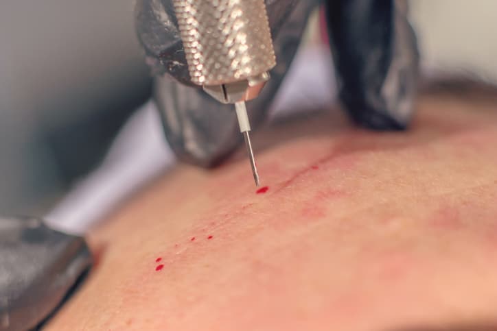 <b>¿Son efectivos? No se sabe</b>. Según la Asociación Estadounidense de Dermatología se han realizado muy pocos estudios para determinar su efectividad, así que nadie puede asegurar certeza si verdaderamente funcionan o no. Como el proceso involucra agujas y una centrífuga en vez de un medicamento como tal, las regulaciones de la FDA a las que está sometido bajo la clasificación de dispositivo médico son menos estrictas o exigentes.