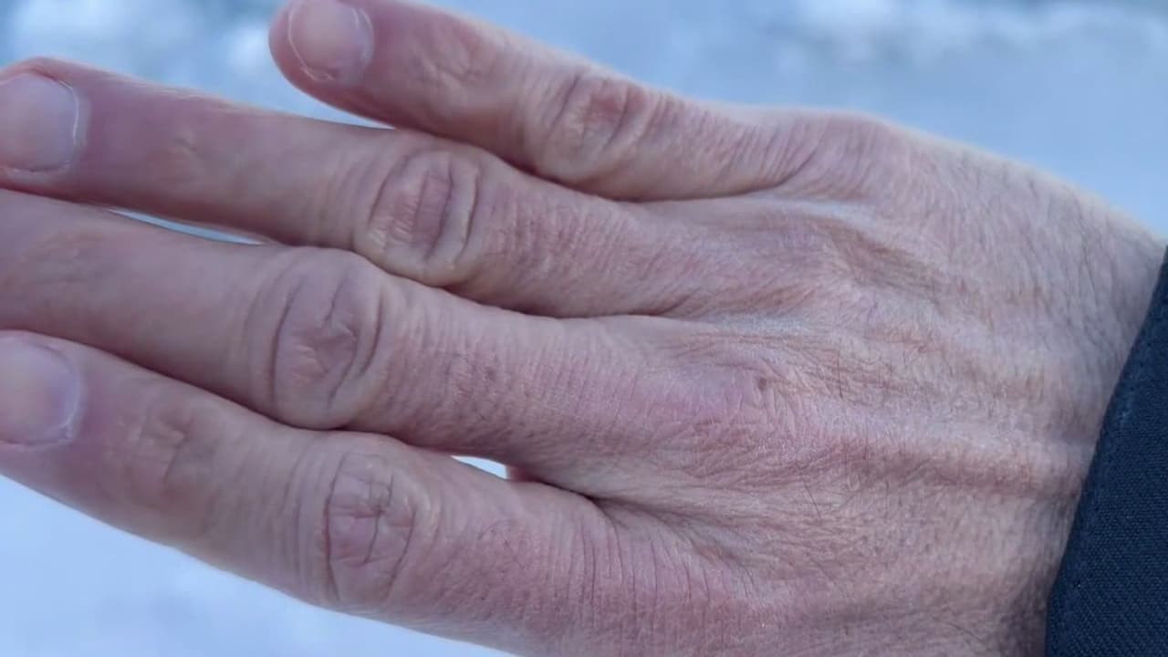 Temperaturas bajo cero pueden provocar lesiones graves en la piel