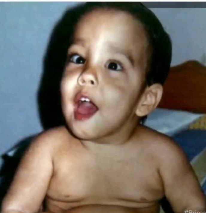 Tras más de un mes en terapia intensiva y luego de sufrir unos 12 paros respiratorios, esa falta de oxígeno, junto a otros factores predominantes arrojaron un diagnóstico doloroso para el pequeño Beyker Hernández,
<b> quien salió del hospital con parálisis cerebral y una escoliosis severa que le ha ido deformando de manera gradual su columna vertebral que requirió una operación de urgencia con el correr de los años. </b>
<br>