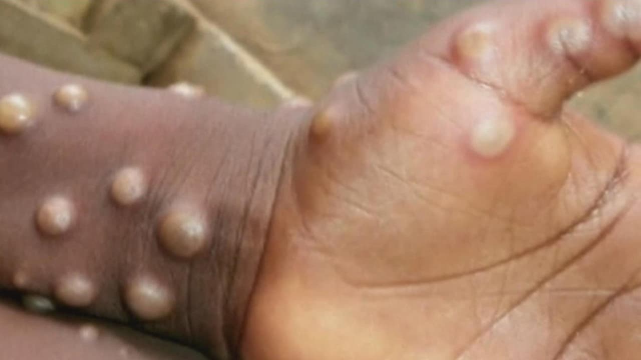 De acuerdo con expertos, el virus no se debe relacionar con ningún grupo en particular. "Es una infección viral y se contagia a través de
<b> contacto superficial</b>", dijo a Univision34 Los Ángeles el infectólogo George Díaz.