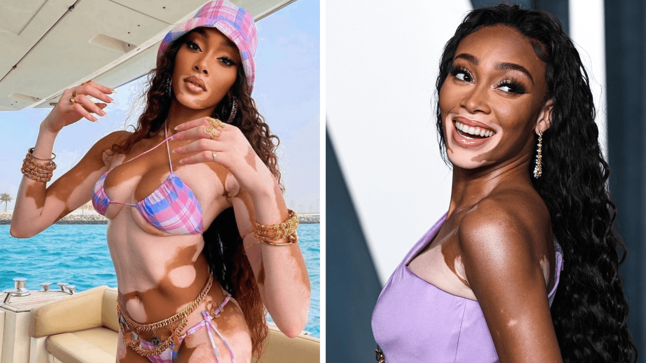 De sufrir bullying a ser ángel de Victoria Secret: conoce a Winnie, la modelo con vitiligo