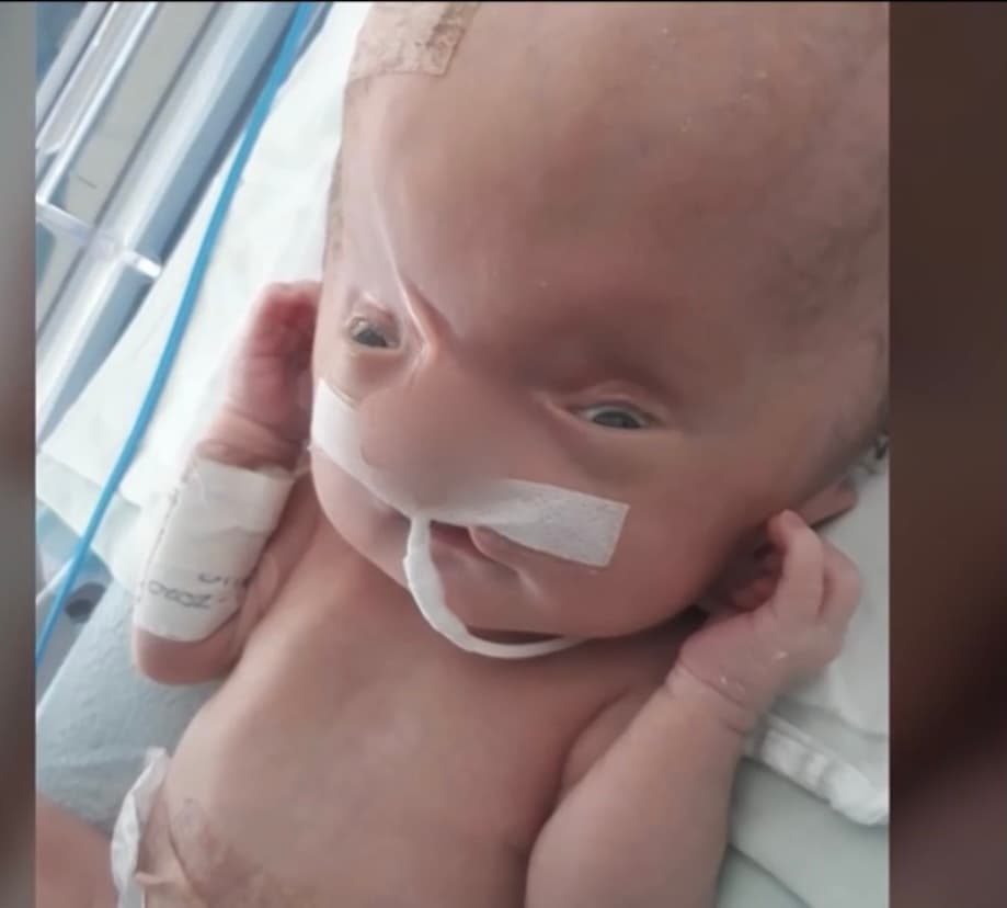 Prieto, quien ayuda constantemente a niños como Emiliano a través de su fundación “Alegría”, señala que el pequeño requiere de varios procesos quirúrgicos para que pueda consumir 
<a href="https://www.univision.com/temas/alimentos">alimentos</a> y corregir partes de su nariz, 
<b>“para darle adecuada respiración”. </b>
<br>