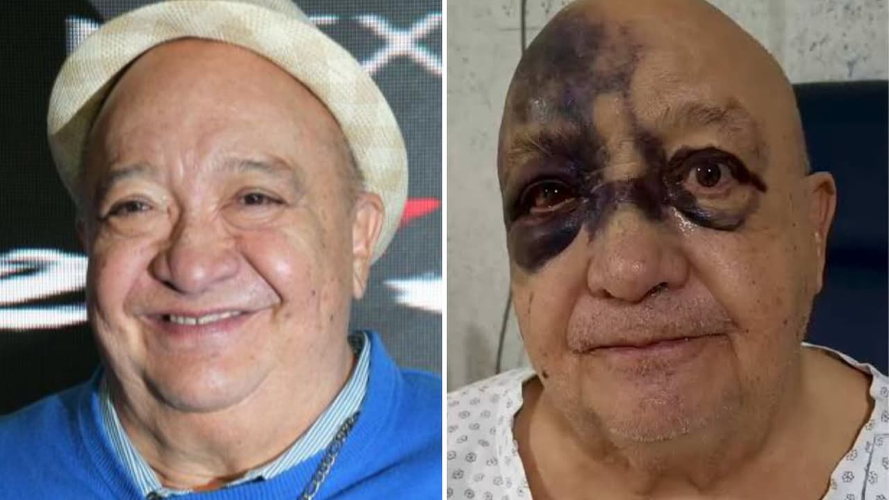 ¿Qué le pasó al comediante Luis de Alba?: revelan detalles de su salud tras aparecer con el rostro morado