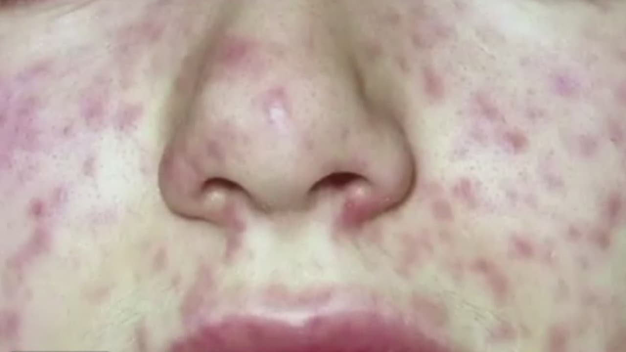 Confirman caso de sarampión en Denton