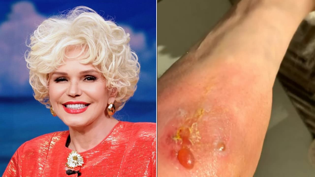 Charytín Goyco sufre picadura de “peligrosa” araña: este es su estado de salud