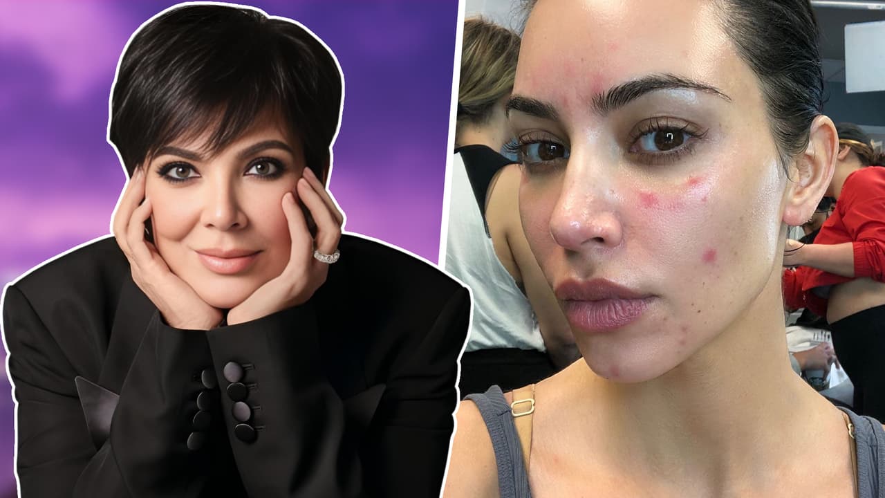 Las enfermedades que Kim Kardashian y su familia ocultaban: tumores, manchas rojas y más