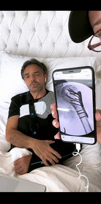 Luego de la cirugía a la que fue sometido, a Derbez le fueron colocados "20 tornillos" en el área del hombro afectado.
<br>