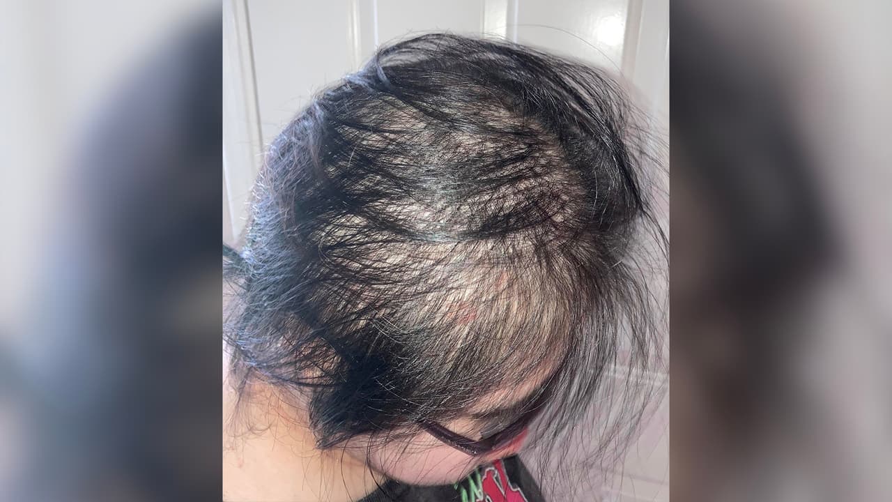 Ambas lograron superar la enfermedad y ya se encuentan en su hogar. Sin embargo, el contagiarse de covid-19 le ha traído consecuencias a Kelsy, quien ha perdido gran parte de su cabello. "Se pone triste porque dice que tiene que regresar a la escuela y le da pena regresar así", dijo la mamá.