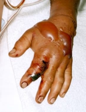 Si es mordido por una de estas víboras las autoridades aconsejan llamar inmediatamente al 911 para recibir atención médica lo antes posible.