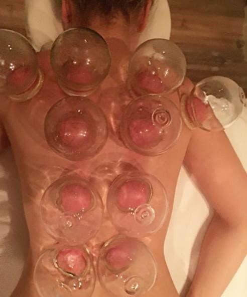 Thalía confiesa ser fiel seguidora del cupping therapy, la cual consiste en la aplicación de ventosas sobre la piel.