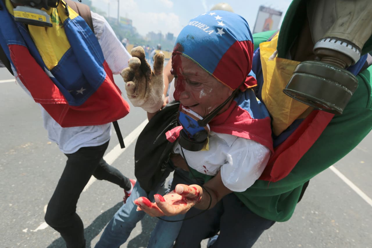 A female activist injured in the head is assisted by fellow protesters. April 26, 2017.