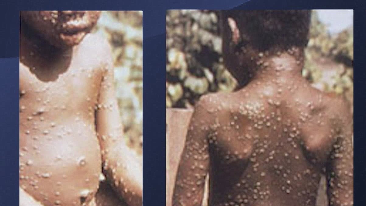 Confirman el primer caso de viruela del mono en Georgia, esto es lo que se sabe 