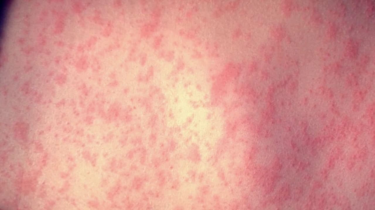 Centro de detención de ICE en Texas está en cuarentena por brote de sarampión; esto se sabe del caso