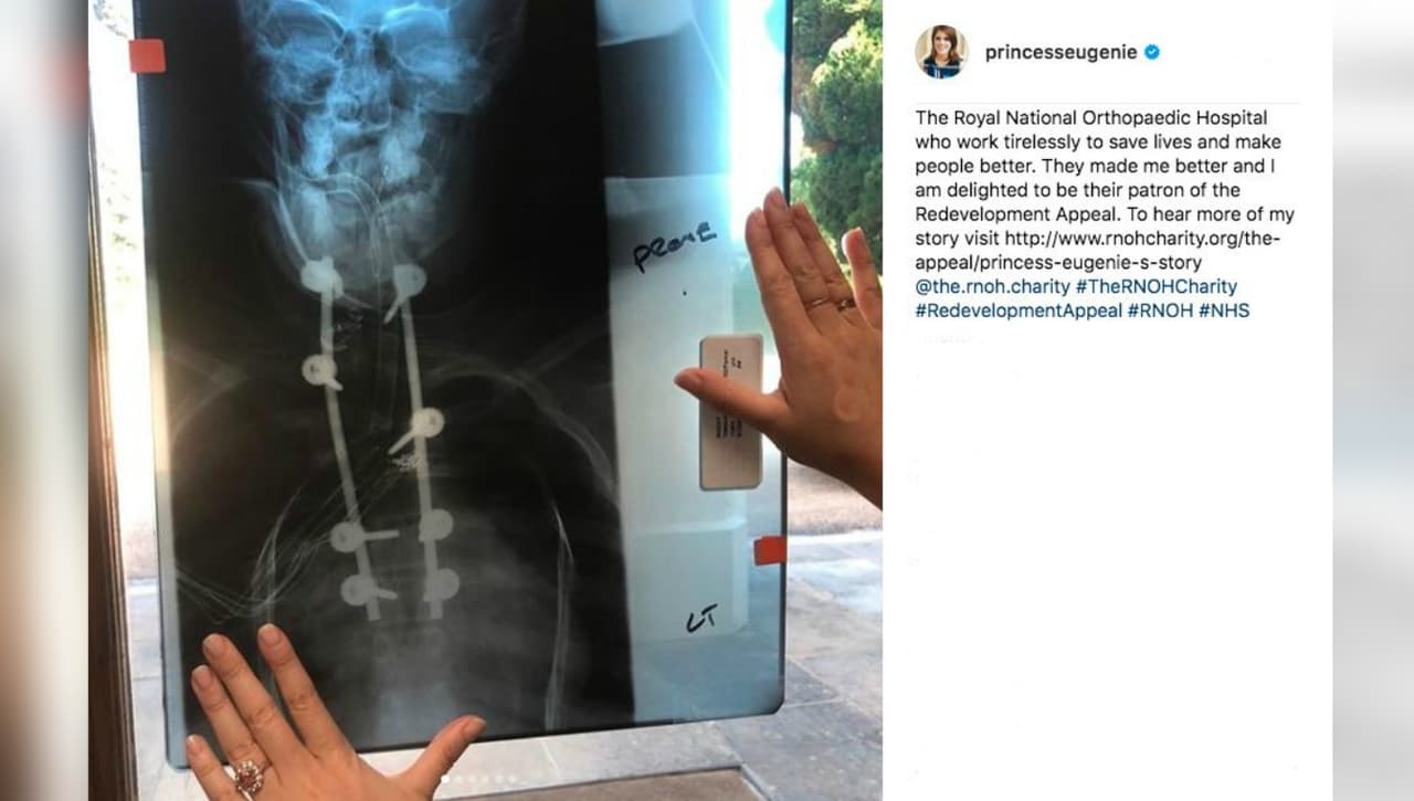 La cirugía correctiva duró "ocho horas. Los cirujanos insertaron 
<b>barras de titanio de ocho pulgadas en cada lado de mi columna vertebral</b> y tornillos de una pulgada y media en la parte superior de mi cuello", 
<b><a href="http://www.rnohcharity.org/the-appeal/princess-eugenie-s-story">relató Eugenie de York en un video que publicó hace seis años</a></b>.