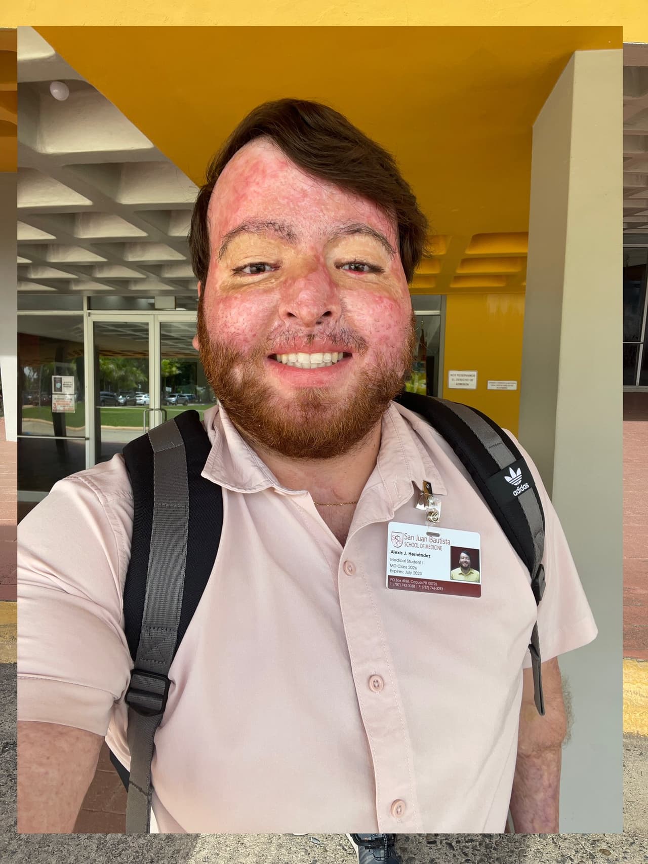 El pasado 27 de junio, el puertorriqueño publicó una foto en redes sociales durante su primer día en la escuela de medicina. “Después de quemar el 71% de mi cuerpo hace 3 años. 28 cirugías y más por venir, 20 días en coma, 2 meses en la UCI, más de 7 meses en el hospital, y 3 años de terapias. Feliz de estar finalmente aquí”, indicó. 
<br>