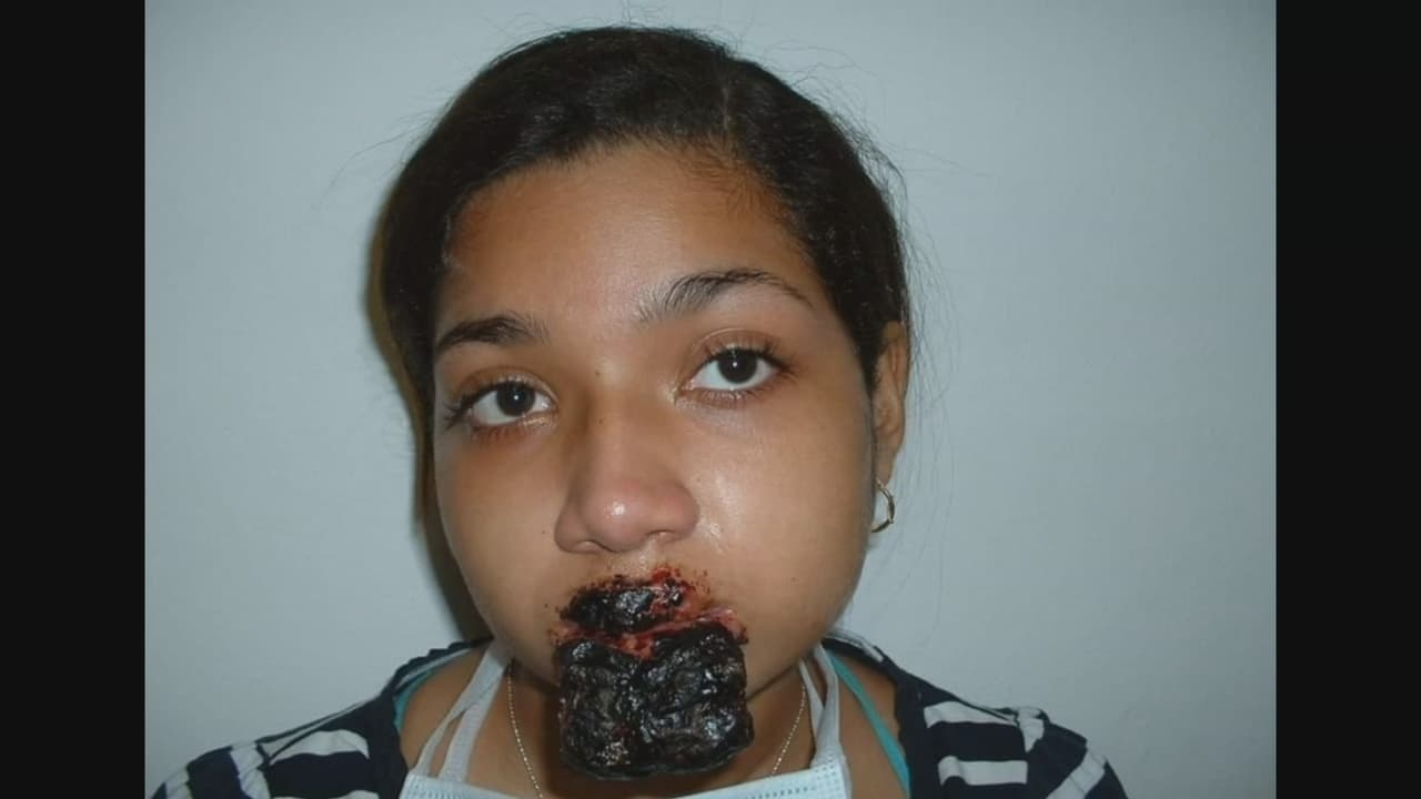 Desesperada y sin saber que más hacer, Coronado implora para que su caso llegue a oídos de un doctor especializado en cualquier parte del mundo para que pueda curarla.
<b> “Ojalá una universidad u hospital pueda interesarse porque necesito salvar mi pierna”</b>, afirma. 
<br>