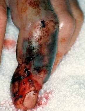 Algunos de los síntomas de una mordida de serpiente son puntos o marcas cerca de la herida, rápida hinchazón, enrojecimiento, moretones, sangrado o ampollas alrededor de la picadura.