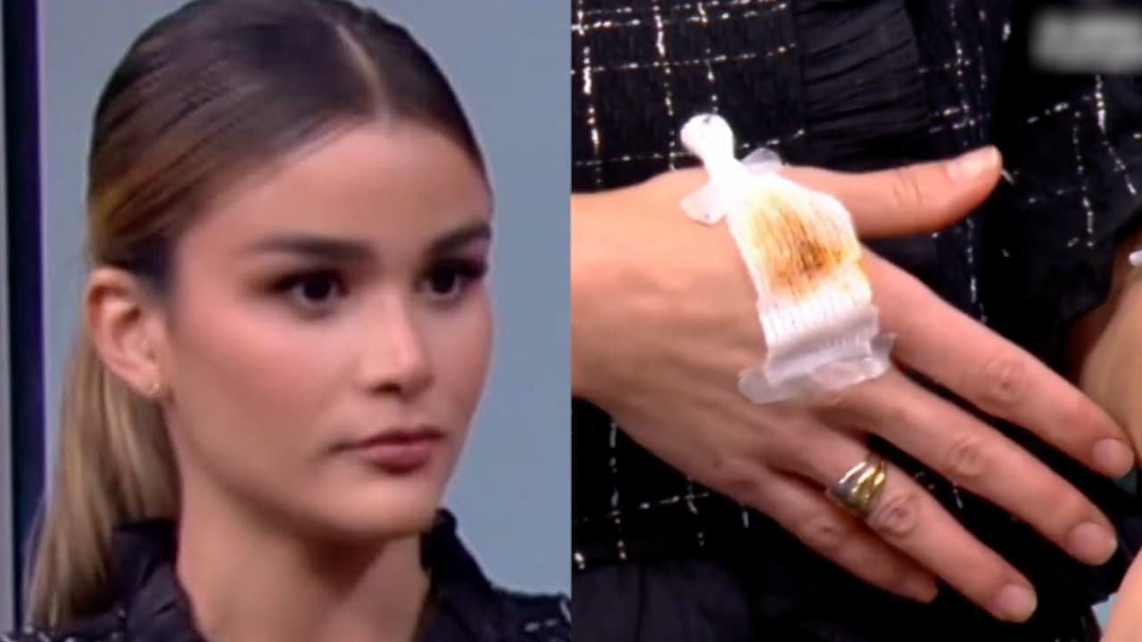 Clarissa Molina sufre accidente y termina con quemaduras en las manos: esto le pasó