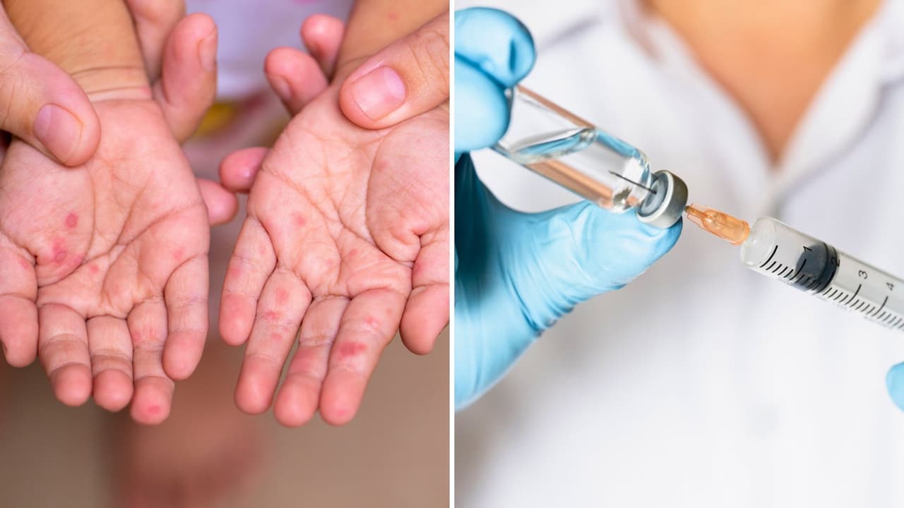 Un menor muere por sarampión en Texas: es el primer fallecimiento de un brote que ya ha afectado a 124 personas en el estado en 2025