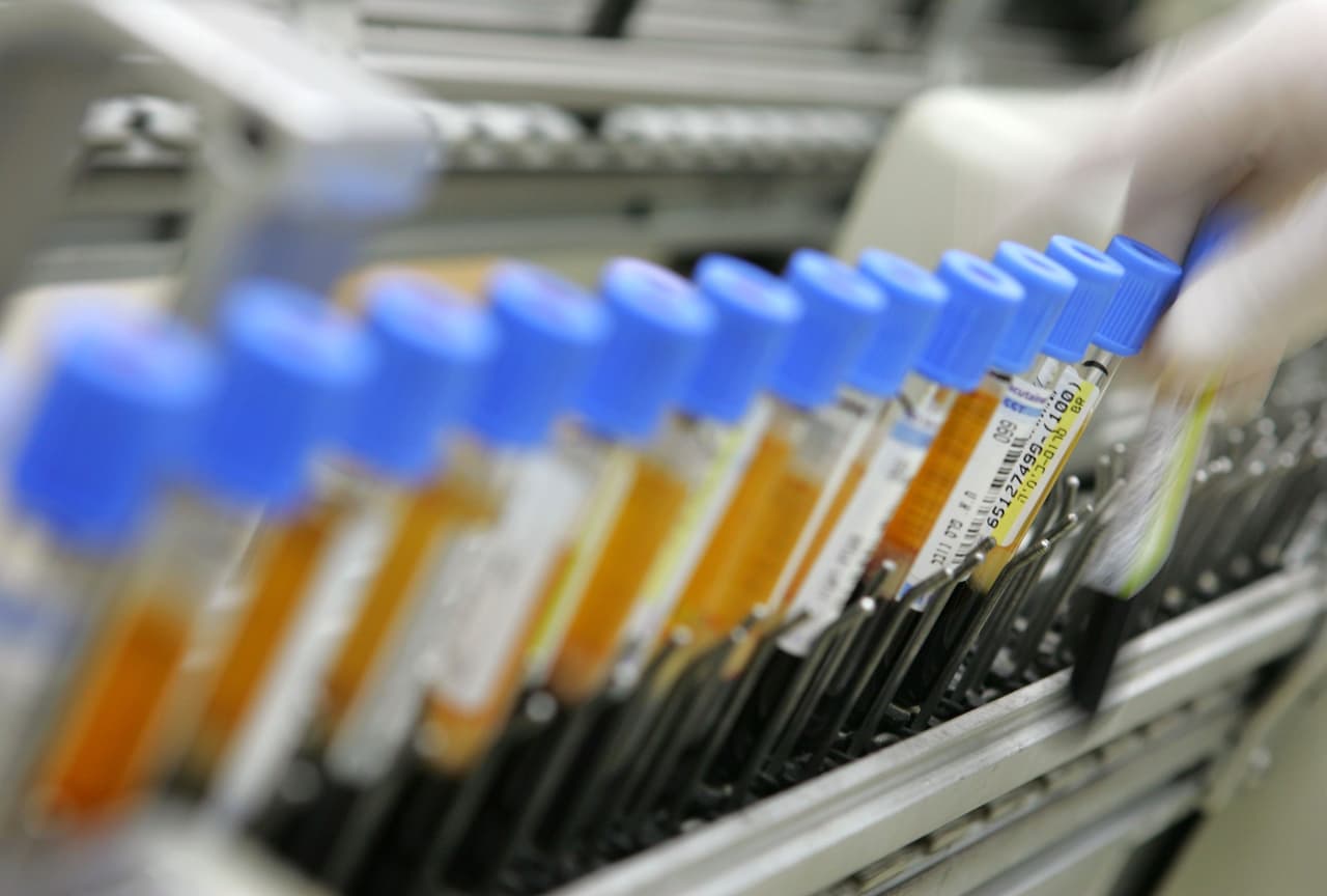 La detección temprana del cáncer de ovario está más cerca