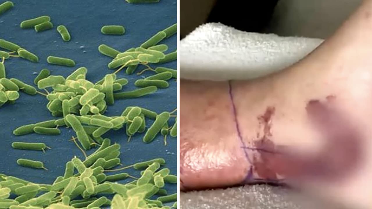 CDC advierte de bacteria "come carne" en Florida tras el paso del huracán Idalia
