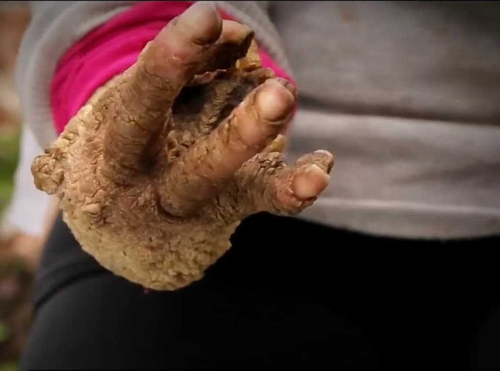 Mientras tanto, conforme la enfermedad sigue su curso, Cañas solo tiene miedo de un día no estar para su hija en un mundo hostil y enferma. Por eso, espera que su tienda les siga dando un poco de dinero para seguirse manteniendo y no tener que volver a salir a la calle para pedir limosna, como alguna vez lo hizo.
<br>