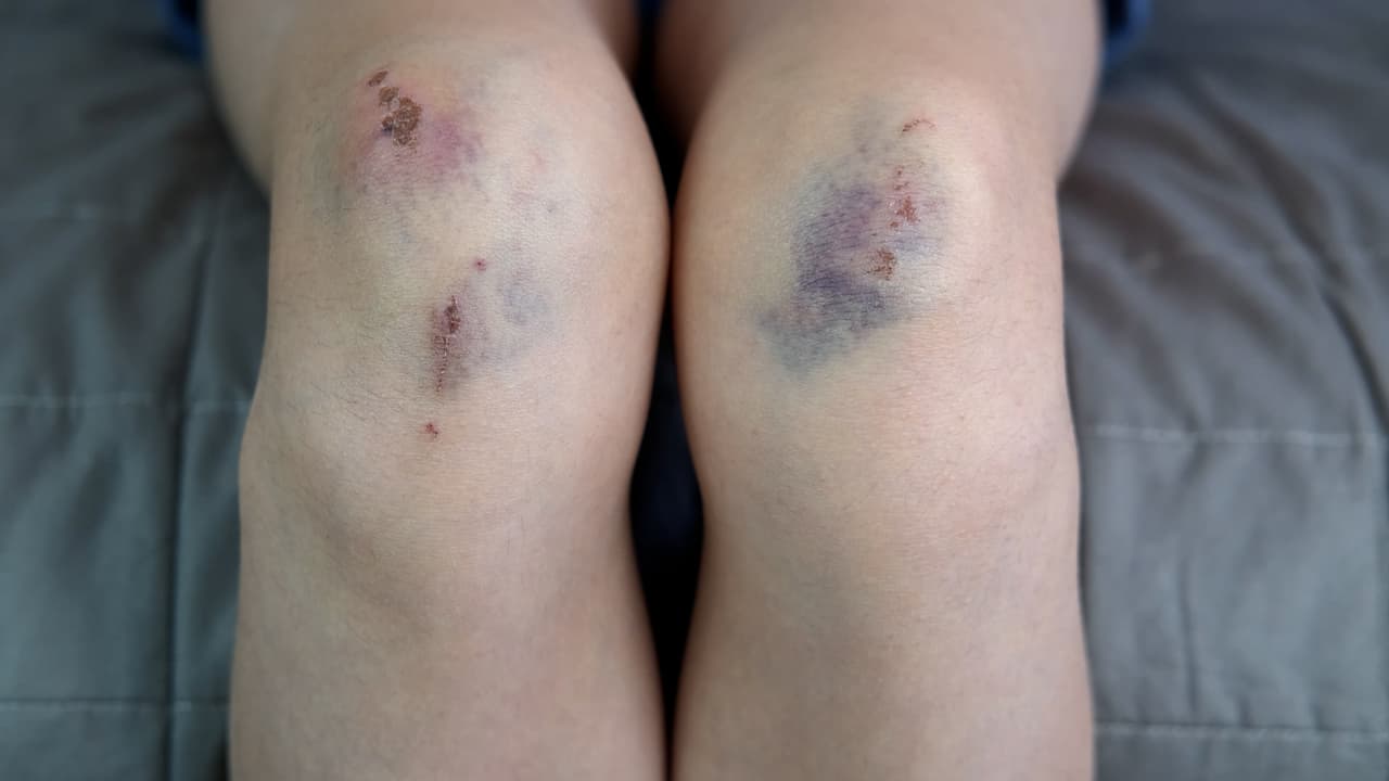 “Una nalgada no es considerada maltrato físico, pero si le pegan al niño con un cinturón o le dejan moretones eso si puede ser considerado maltrato físico”, mencionó Mintz.