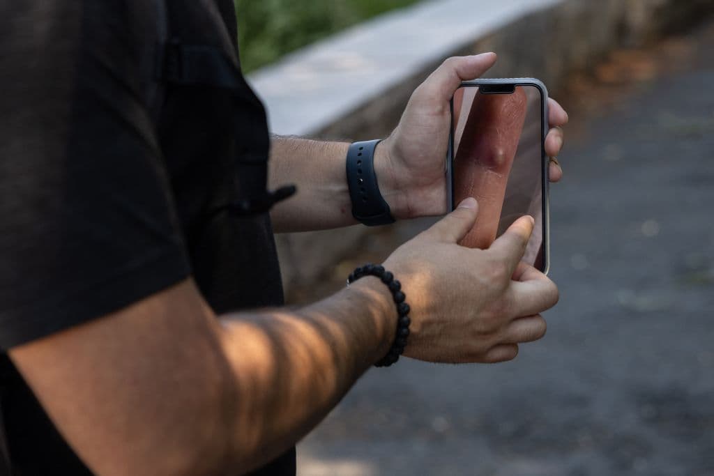 Al principio de la infección, la viruela del mono se puede 
<b>confundir con la varicela y el sarampión</b>. Si hay inflamación de los ganglios linfáticos, es viruela símica. La erupción en la piel suele comenzar entre 1-3 días después de que aparezca la fiebre y se concentra sobre todo 
<b>en la cara y las extremidades</b>. En la imagen, un neoyorquino recuperado muestra cómo tenía la piel durante la enfermedad.