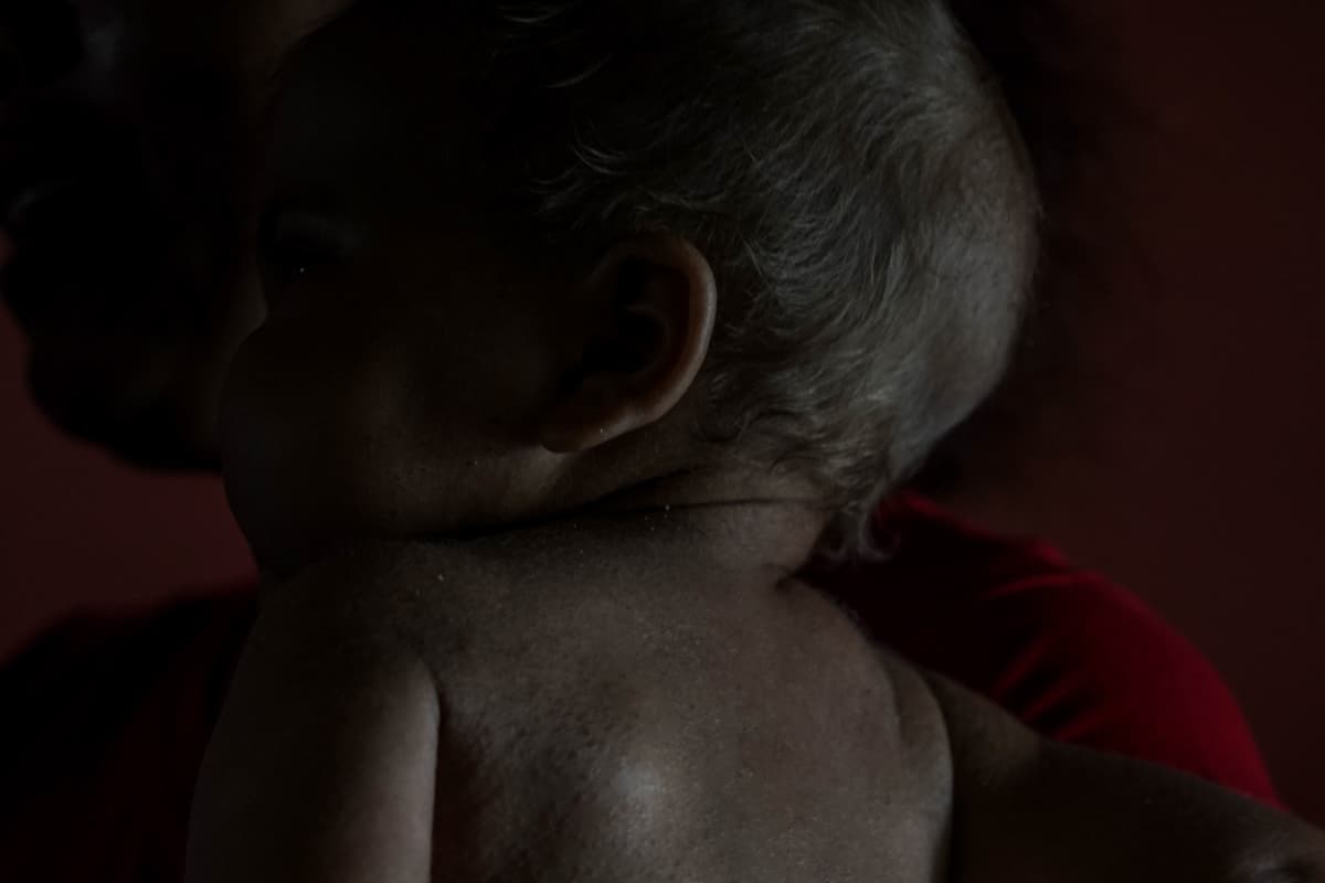 La hinchazón, las manchas en la piel y el cabello amarillo son algunos de los síntomas del
<i>kwashiorkor</i>.
<br>