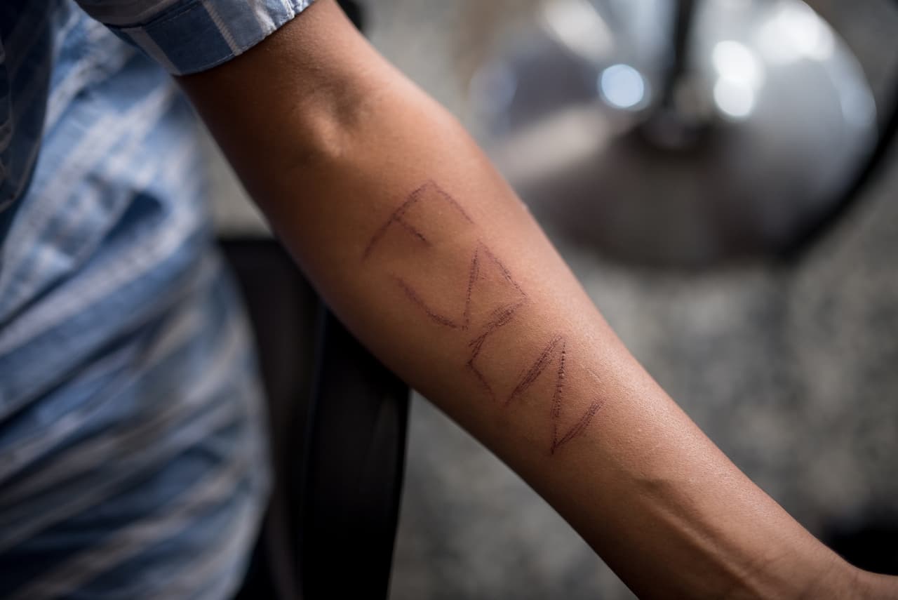 El joven aseguró que le tatuaron las siglas del partido de gobierno con una jeringa que contenía un líquido.