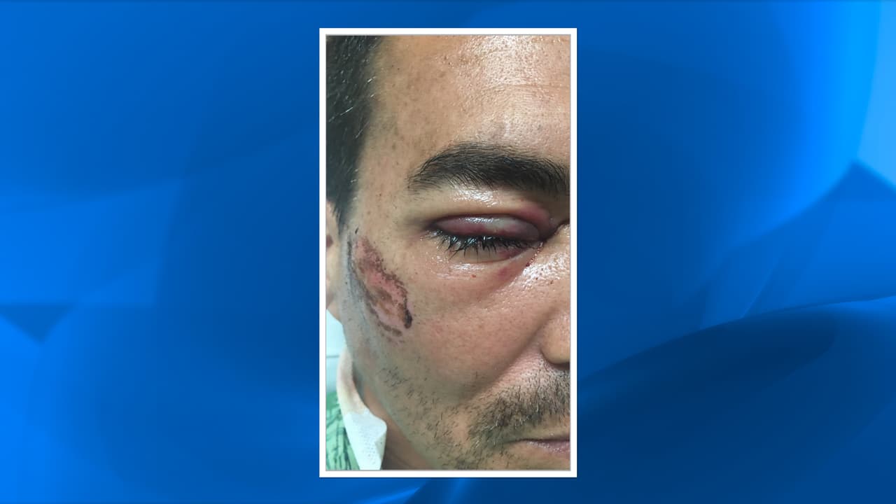 El abogado de Gustavo Castaño informó que este perdió el ojo derecho por un disparo de pistola taser realizado por la policía.