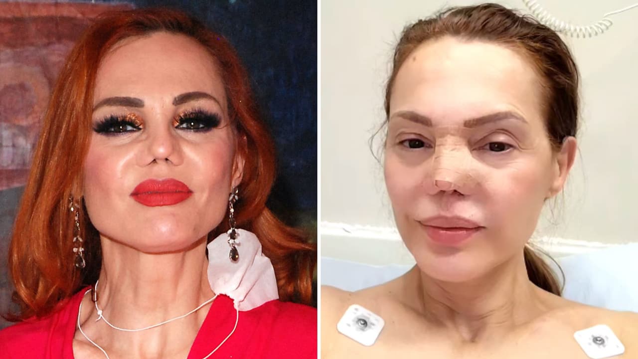 Carmen Campuzano se somete a cirugía tras “perforación” en la nariz a causa de unos lentes