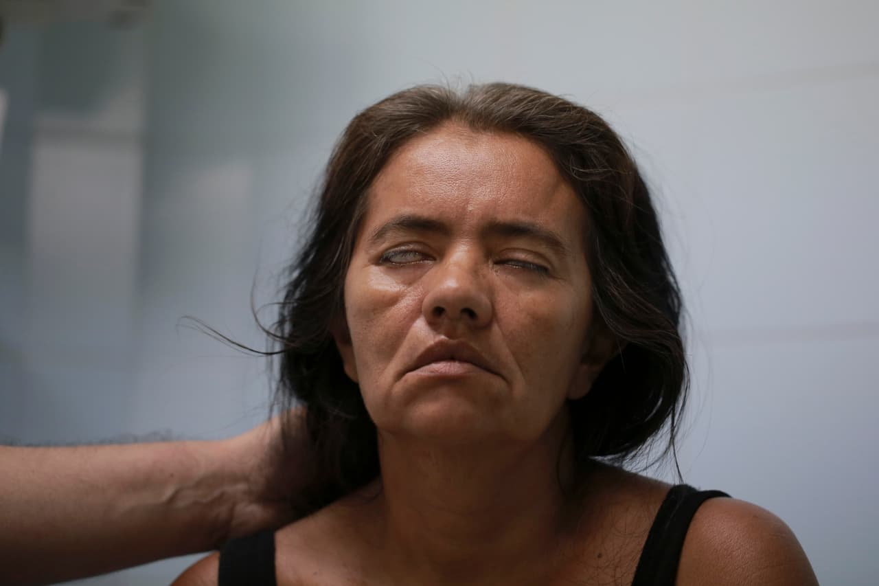 Zulay Balza tiene Guillain-Barré. No puede cerrar sus ojos.