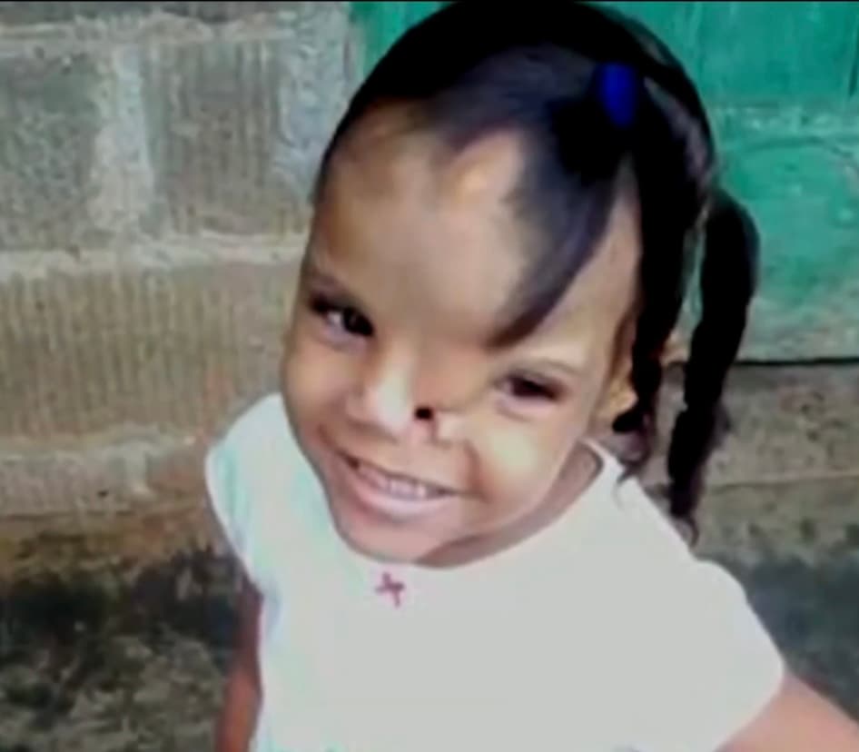 Desde que Luz Mariel Blanco era muy pequeña, su madre supo que algo no estaba bien con su rostro. Y aunque ella siempre la ha visto hermosa, entiende que tiene que resolver el problema que tiene hundida anímicamente a su hija de 13 años. 
<br>