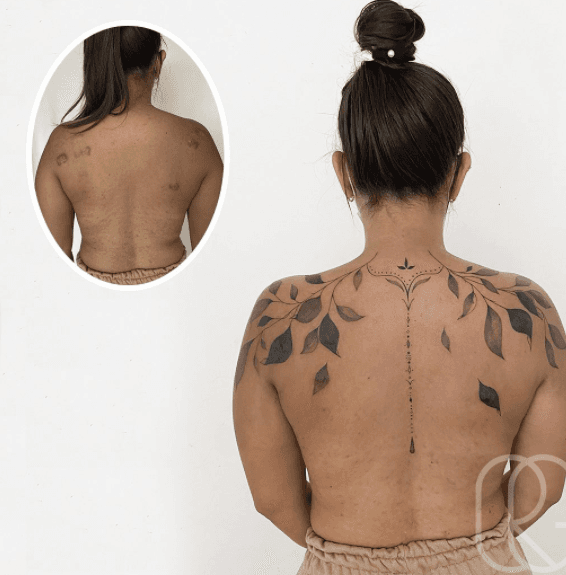 Esta chica de 25 años tenía diversos granos en la espalda y se los exprimía con un palillo, haciendo que cicatrizarán tipo queloide. La tatuadora lo que hizo fue cubrirlas con dibujos florales.