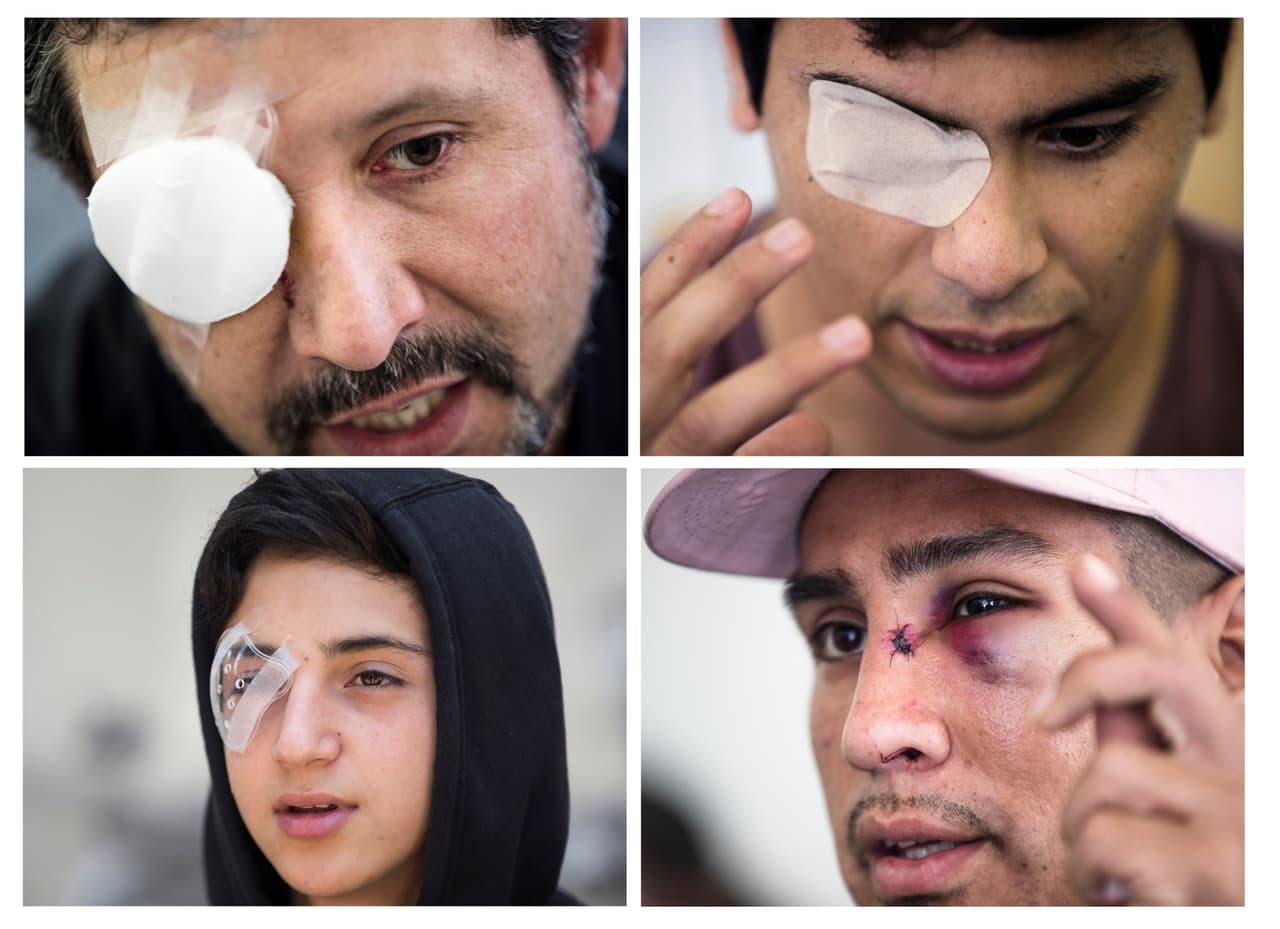 "Muchos necesitarán hasta 5 operaciones": las denuncias de abuso policial que dejó unos 200 manifestantes con lesiones oculares en Chile