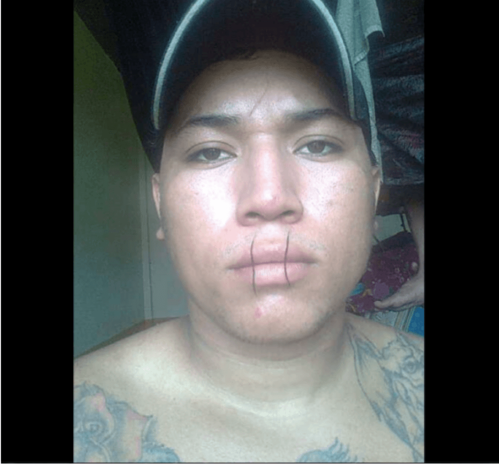 El recluso Jairo Urbina se cosió los labios en protesta por los abusos dentro de la cárcel.