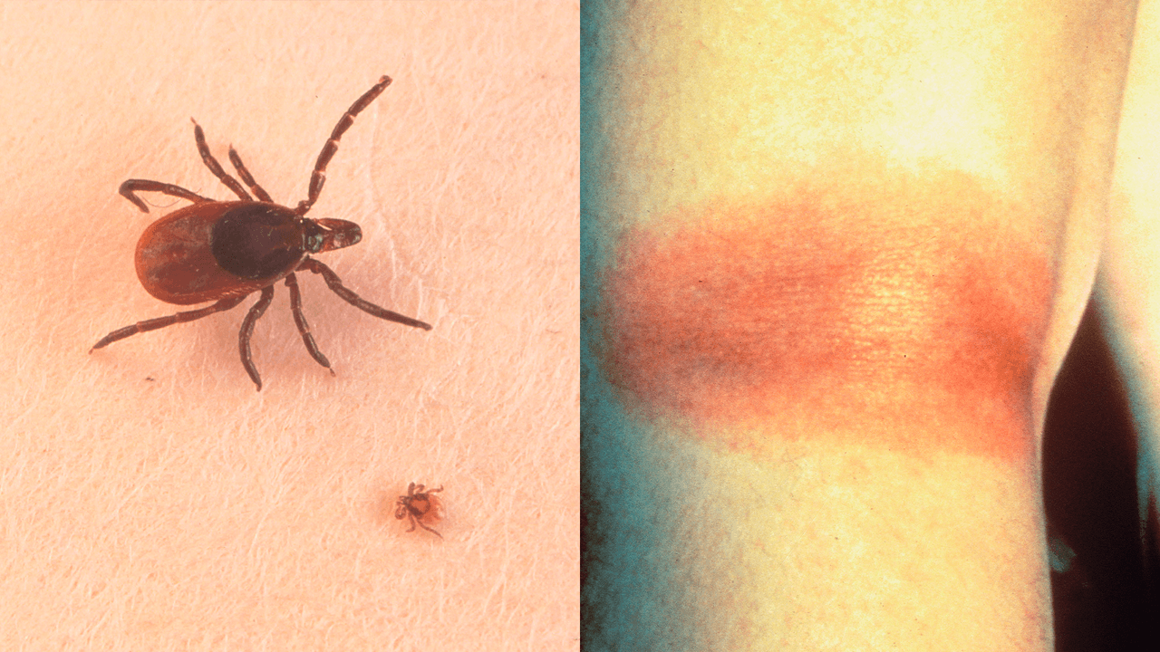 Fiebre, dolor de cabeza y malestar: los síntomas de una enfermedad transmitida por garrapatas
