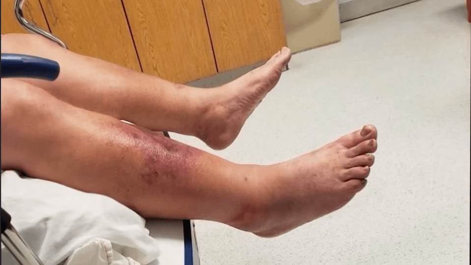 Bacteria 'come carne' se está proliferando en EEUU debido al calentamiento global, advierten expertos