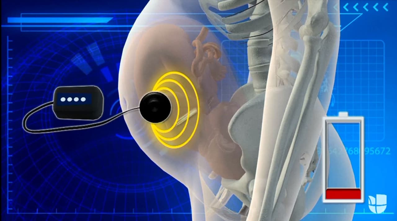 Este pequeño marcapasos puede colocarse dentro del feto durante el embarazo: una esperanza para cientos de bebés con cardiopatías