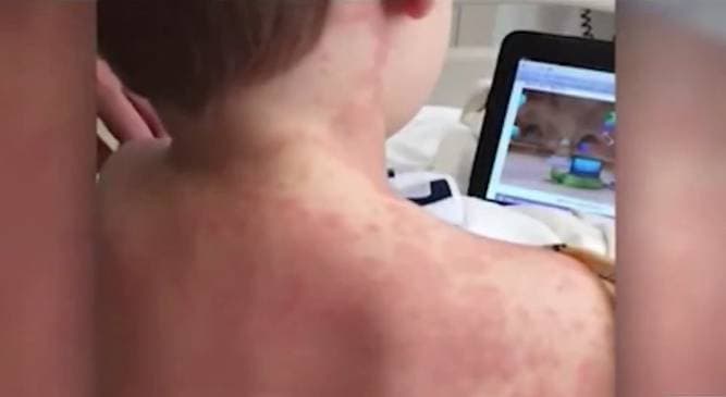 Reportan 100 casos de niños con síndrome inflamatorio relacionado con el coronavirus en Los Ángeles