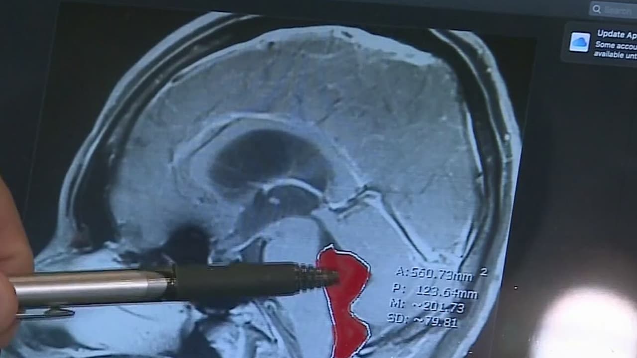 “Tenía un gusano en el cerebro”:  Viajó a México hace una década y llegó a Texas con un parásito