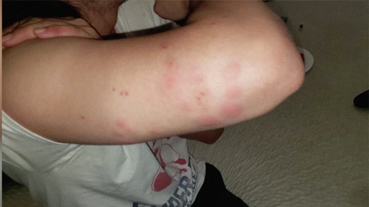 Pero su hijo y su esposa empezaron a 
<a href="https://www.univision.com/local/sacramento-kuvs/familia-hispana-compra-un-sofa-por-internet-sin-saber-que-estaba-lleno-de-chinches?3=" target="_blank">tener picaduras en varias partes de su cuerpo</a>.