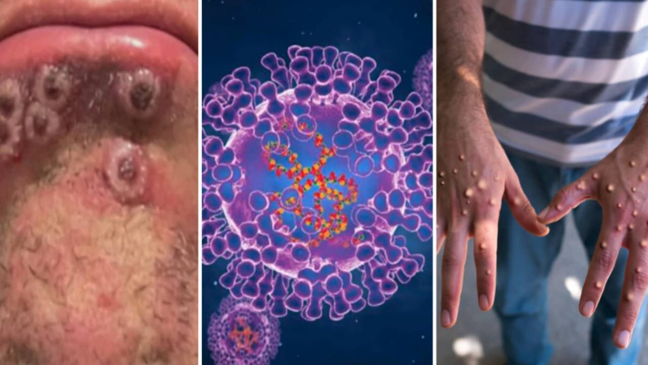 Confirman un caso de viruela del mono o 'monkey pox' en Central High School de Keller ISD