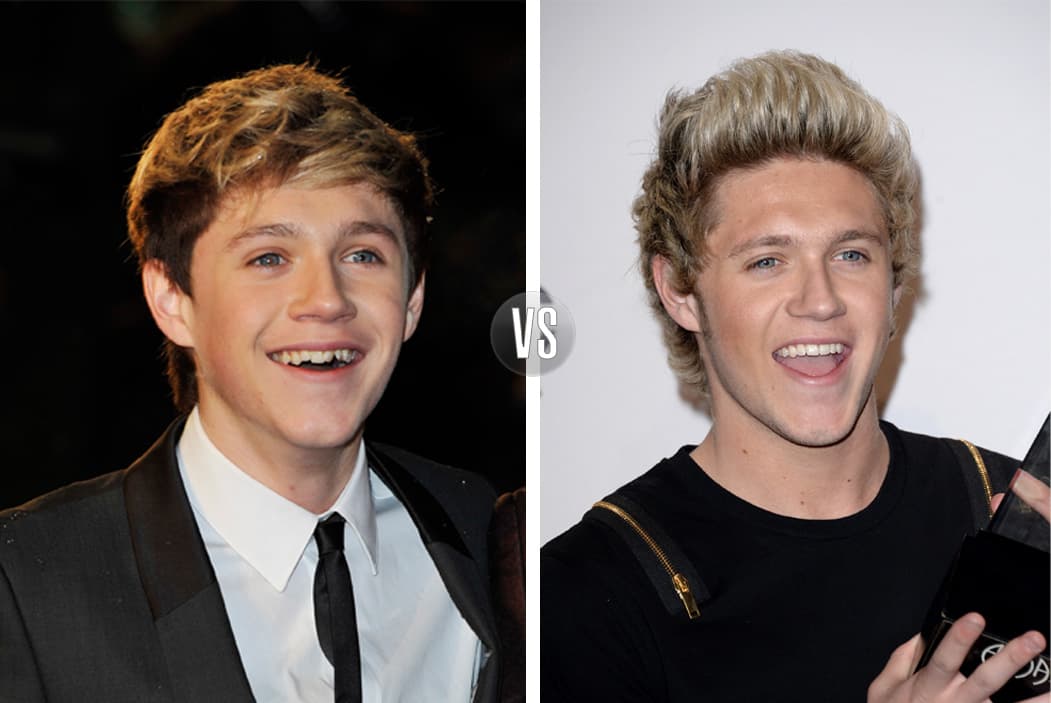Niall Horan, de One Direction, ha trabajado muy duro para sacar a flote su galanura, por eso se arregló los dientes. ¡Mira la diferencia!