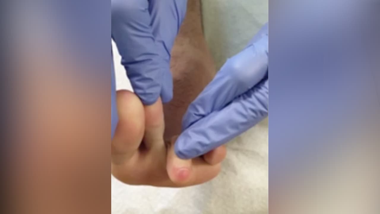 Las manifestaciones pueden surgir desde un inicio o hasta que el paciente se encuentra grave, internado en un hospital.