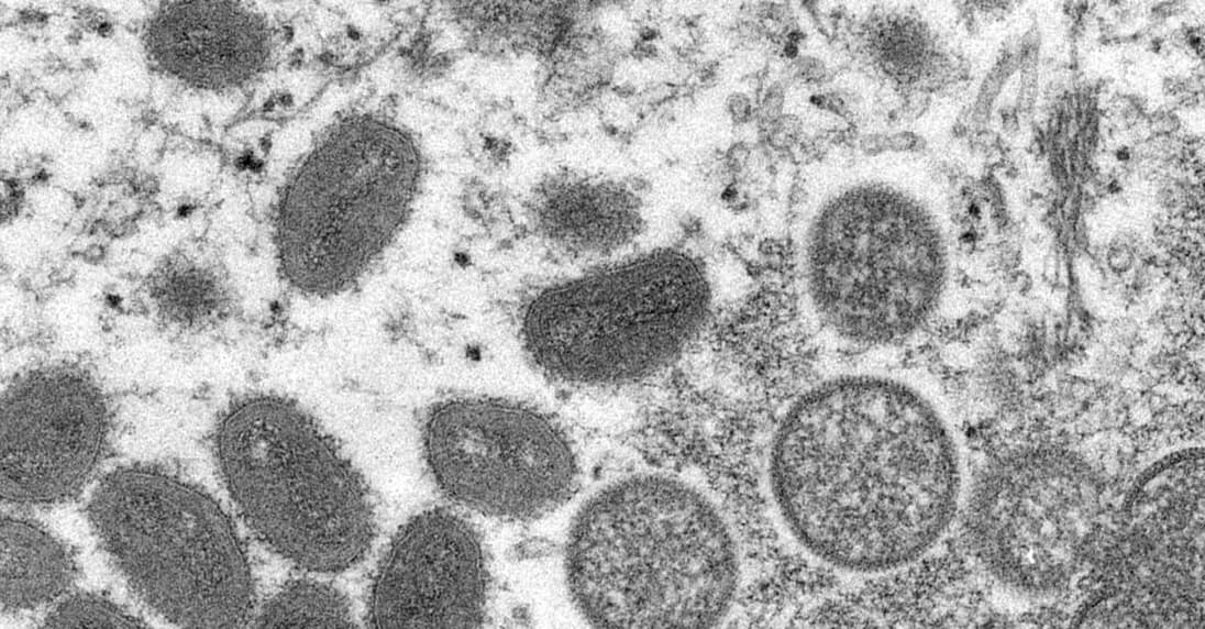 Las autoridades de salud hacen un llamado a estar atentos a los posibles síntomas que incluyen 
<b> fiebre, escalofríos, sarpullido y lesiones en la cara o los genitales</b> que se asemejan a las causadas por la viruela.
<br>
<br>El virus generalmente se ha propagado a las personas a través de animales infectados como roedores, aunque se sabe que ocurre transmisión de persona a persona.
<br>
<br>Entre las personas, 
<b>la enfermedad se transmite mediante el contacto cercano con lesiones, fluidos corporales, gotitas respiratorias</b> o materiales contaminados, como sábanas. Pero hay indicios de que podría haber un "medio de propagación potencialmente novedoso", indicó Neil Mabbott, experto en enfermedades de la Universidad de Edimburgo.