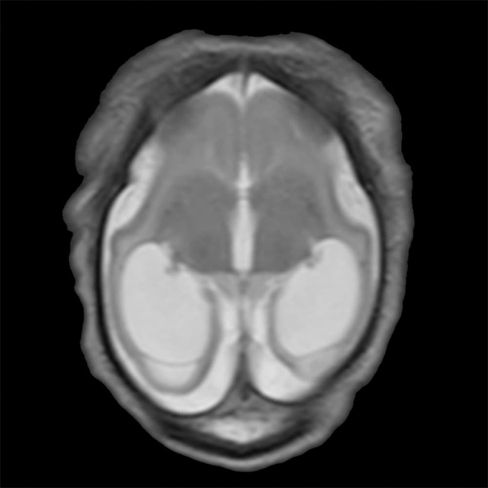 Hasta la semana 28 los ultrasonidos no dieron indicaciones de malformación.