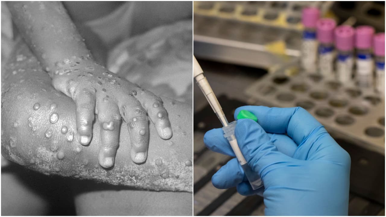 Suben a 128 los casos de Viruela del Mono en Nueva York